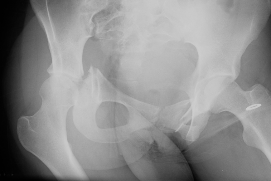 Pelvic Fracture Transverse